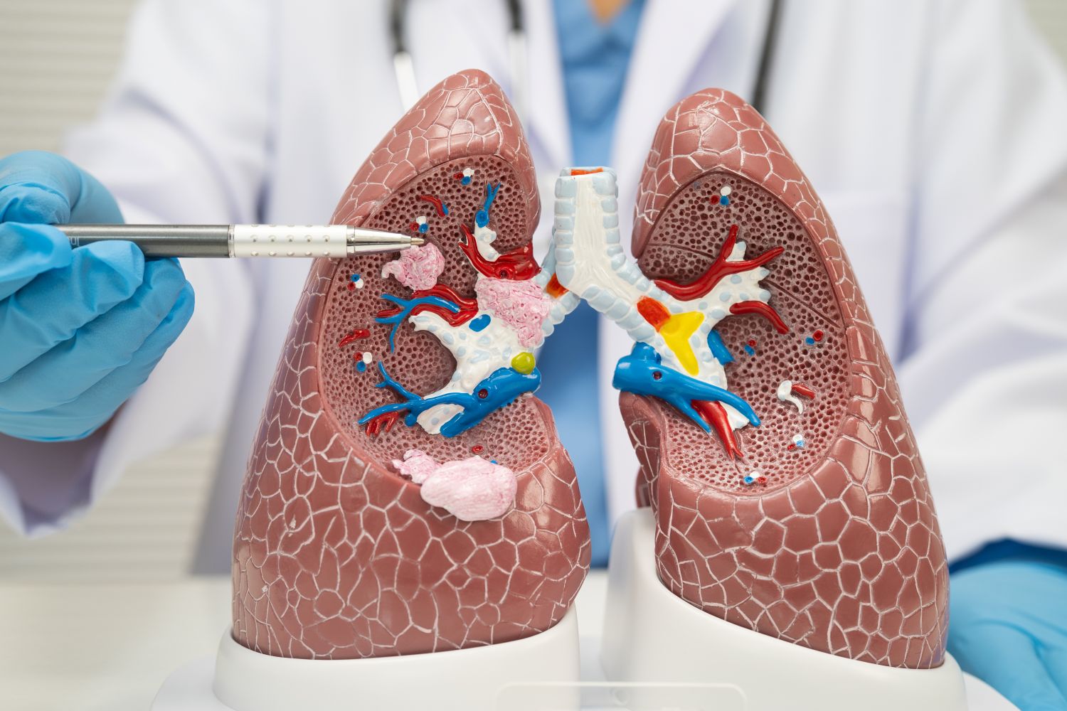 Bronchitis