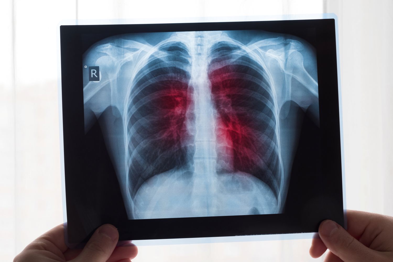 Pneumonia